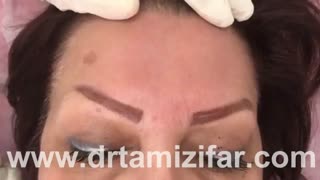 درمان لک های دست و صورت لیزر صورت