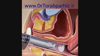 جوانسازی واژن با لیزر فرکشنال زاویه سازی صورت