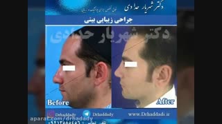 جراحی بینی