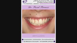 تسریع درمان ارتودنسی | دکتر فاضل فیروزی لیپوماتیک