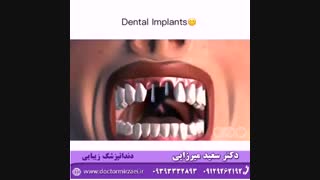 ایمپلنت دندان