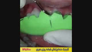 روکش موقت دندان