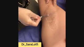 تزریق بوتاکس زیر بغل ترمیم دندان