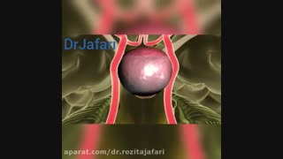 جراحی آندوسکوپی غده هیپوفیز