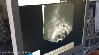 درمان ناباروری با IVF توسط دکتر بهناز عطار شاکری پاکسازی پوست