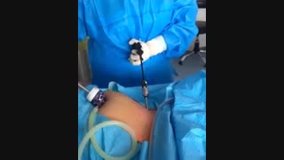 لاپاراسکوپی
