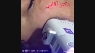 توضیحات کامل دکتر حمیده آقایی در ر ابطه با هایفوتراپی اصلاح فرم صورت