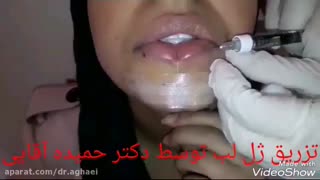 تزریق ژل لب توسط دکتر حمیده آقایی اکستنشن تاج دندان