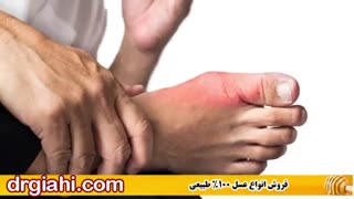 درمان قطعی نقرس
