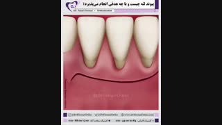پیوند لثه | دکتر فاضل فیروزی ترمیم لبخند لثه‌ای