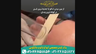 ازبین بردن تتو با لیزر کلینیک مو