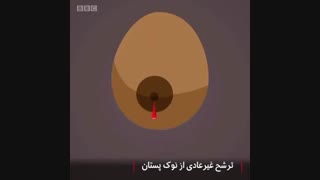 تشخیص سرطان سینه