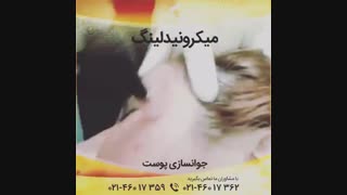 میکرونیدلینگ دندانپزشکی کودکان