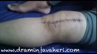 جلسه دوازدهم فیزیوتراپی بعداز عمل جراحی تعویض کامل مفصل زانو