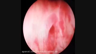 یک مورد نادر از حالب نابجا