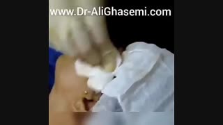 فیلم تزریق چربی به گونه پاکسازی پوست