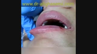 تزریق ژل به لب