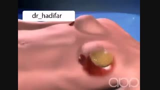 پروتز سینه