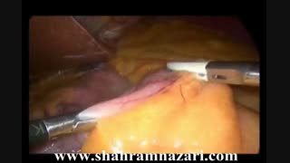 اسلیو معده در چاقی