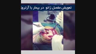 تعویض مفصل زانو
