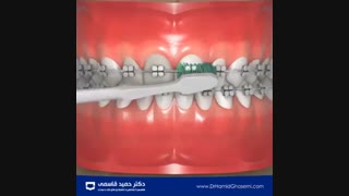 نحوه صحیح مسواک زدن برای دندان های ارتودنسی شده