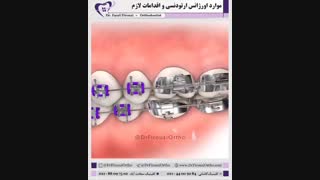 ارتودنسی ثابت | دکتر فاضل فیروزی پلاسماجت