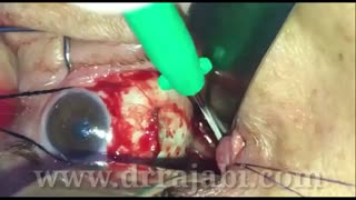 باز کردن غلاف عصب بینایی یا فنستراسیون