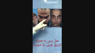 عمل بینی به همراه تزریق چربی