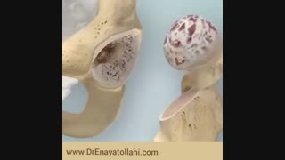 تعویض مفصل لگن