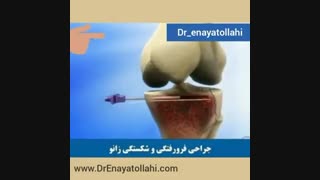 جراحی شکستگی زانو
