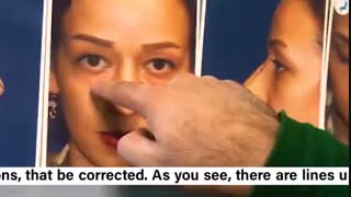 جراحی بینی و تزریق چربی